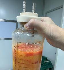 盐城水动力吸脂手术要做多久？
